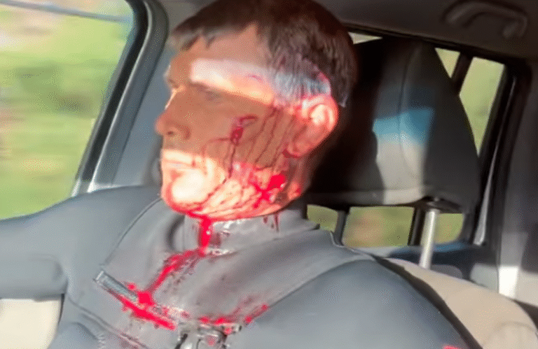 Jamie Mitchell Injured on North Shore Opening Swell Facial Wounds